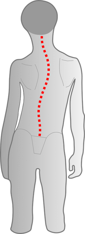 Kind mit Skoliotischer Fehlhaltung