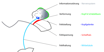Symptomenkomplex der haltungsasymmetrie im saeuglingsalter