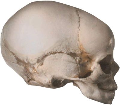 Baby Kopfform beurteilen verschobene Ohrachse bei Plagiocephalus